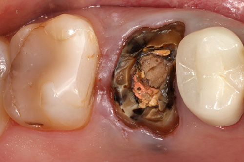 Towson General and Implant Dentistry | Invisalign reg , Teeth Whitening and Oral Exams