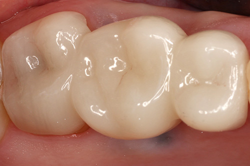 Towson General and Implant Dentistry | Dental Bridges, CEREC reg and Dental Fillings