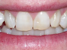 Towson General and Implant Dentistry | Crowns amp Caps, Night Guards and Oral Exams