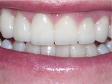 Towson General and Implant Dentistry | Implant Dentistry, Dental Bridges and Invisalign reg