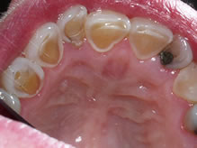 Towson General and Implant Dentistry | Dentures, CEREC reg and Preventative Program