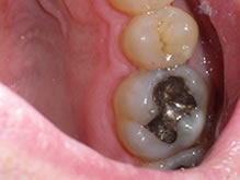 Towson General and Implant Dentistry | Dental Fillings, Invisalign reg and Emergency Treatment