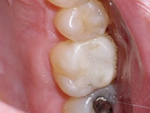 Towson General and Implant Dentistry | Dentures, Emergency Treatment and Implant Dentistry