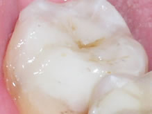 Towson General and Implant Dentistry | Crowns amp Caps, CEREC reg and Extractions