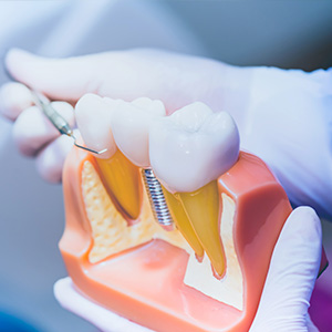 Towson General and Implant Dentistry | Root Canals, Veneers and Dentures
